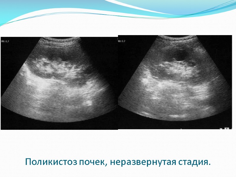 Поликистоз почек, неразвернутая стадия.